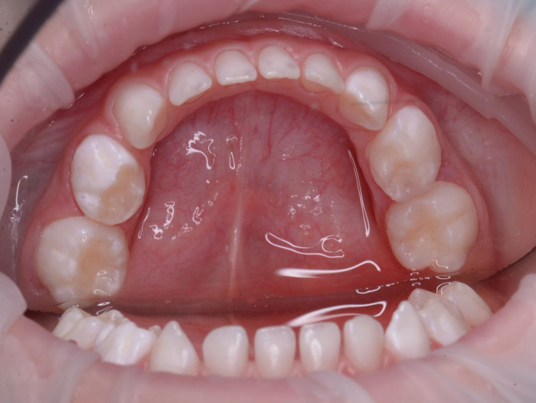  - photo after the procedure