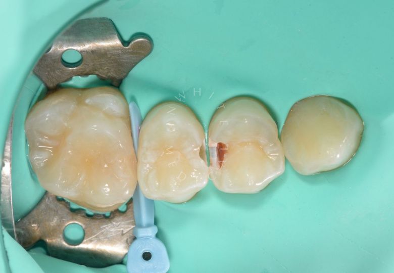 Детская стоматология Раменки. Лечение контактного кариеса 2-х зубов у детей - фото до процедуры
