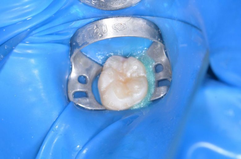  - photo after the procedure