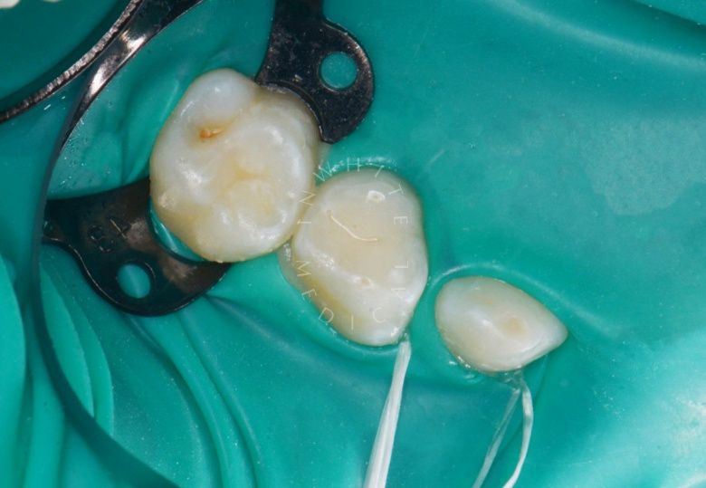 Самые лучшие детские стоматологи. Лечение кариеса у детей за один визит - фото до процедуры