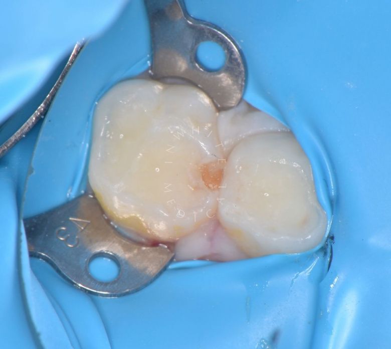 Лучшие стоматология для детей. Лечение межзубного кариеса у детей - фото до процедуры