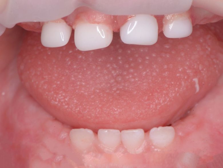  - photo after the procedure