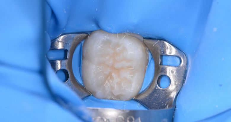 Лучшие детские стоматологии. Герметизация фиссур - фото до процедуры