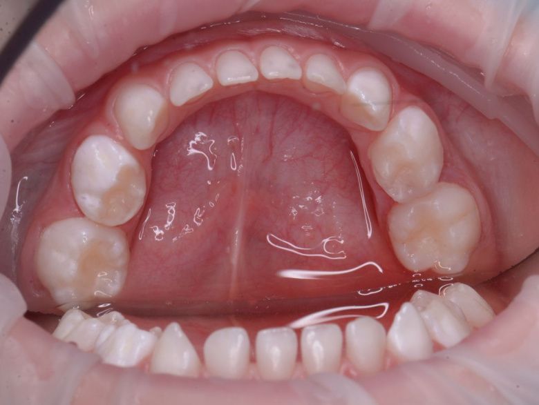  - photo after the procedure