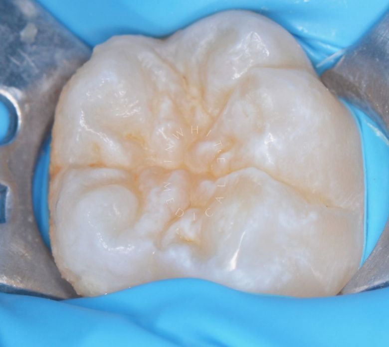 Лучшие стоматология для детей. Герметизация фиссур постоянного зуба у детей - фото до процедуры