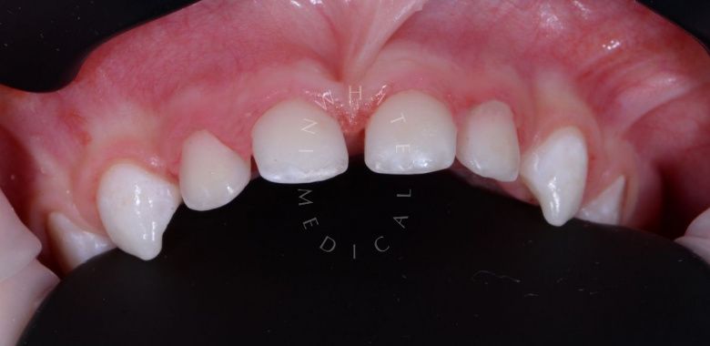 Самые лучшие детские стоматологи. Установка коронок и лечение зубов детям во сне - фото после процедуры