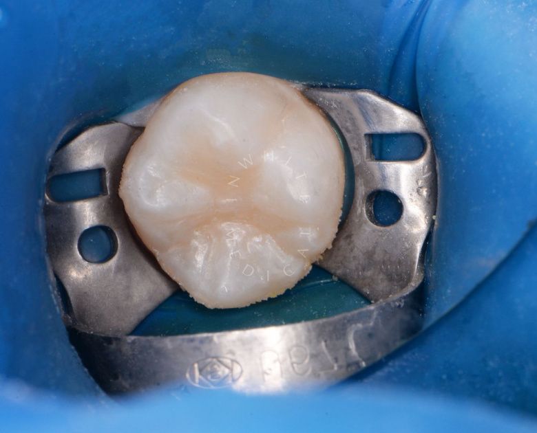  - фото после процедуры