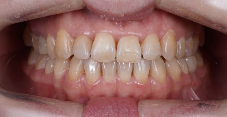  - photo after the procedure