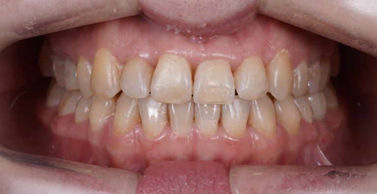  - photo after the procedure