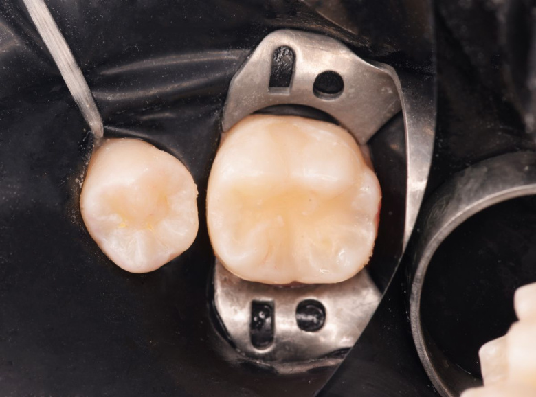  - photo after the procedure