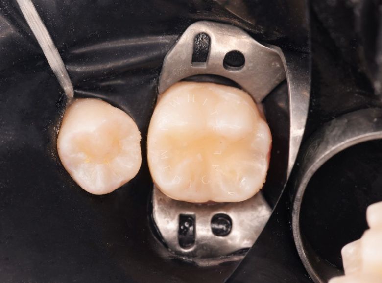  - фото после процедуры