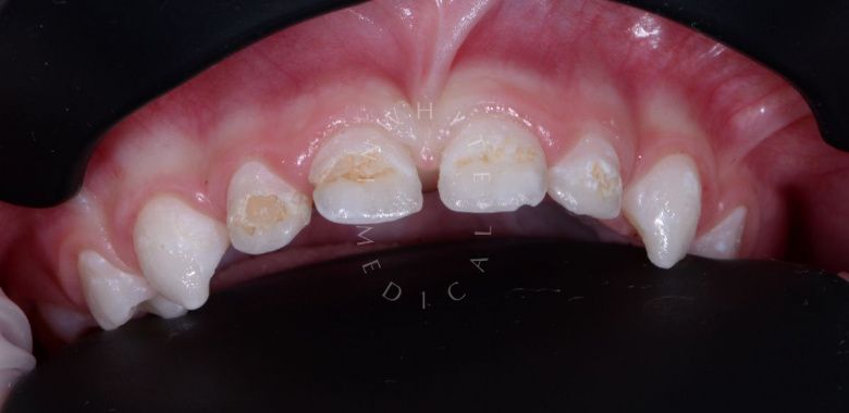Самые лучшие детские стоматологи. Установка коронок и лечение зубов детям во сне - фото до процедуры